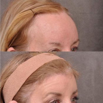 ForeheadPlasty / Hairline Lowering - Right Side