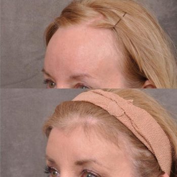 ForeheadPlasty / Hairline Lowering - Left Side