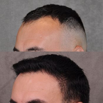 A combination of a FUE hair transportation and PRP treatment