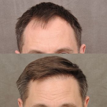 This lovely patient got a FUE hair transplant with our enhanced PRP treatment. 