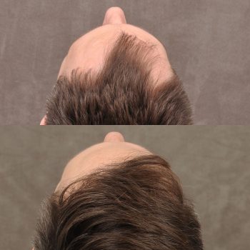 This lovely patient got a FUE hair transplant with our enhanced PRP treatment. 