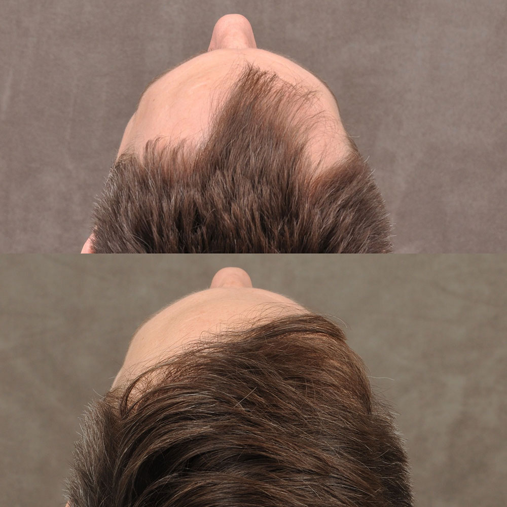 Beverly Hills Hair Transplant Before and After Pictures, Results