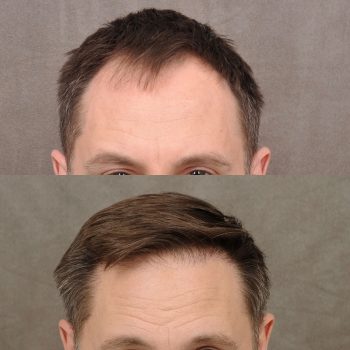 This lovely patient got a FUE hair transplant with our enhanced PRP treatment