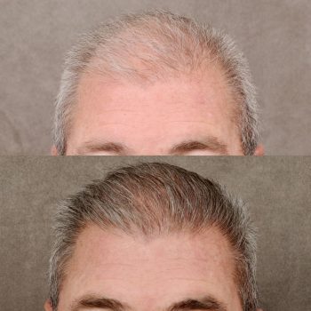 FUE Hair Transplant with 2,000 grafts and PRP treatment