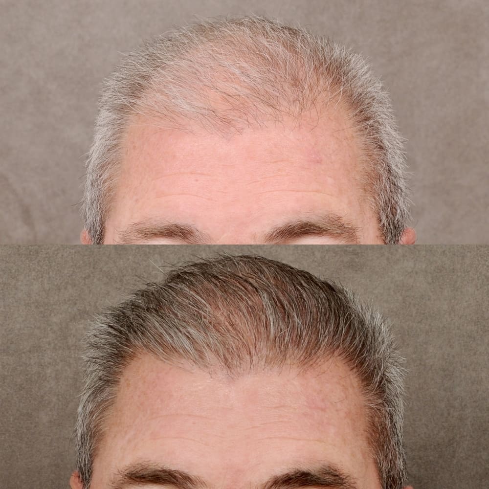 Beverly Hills Hair Transplant Before and After Pictures, Results