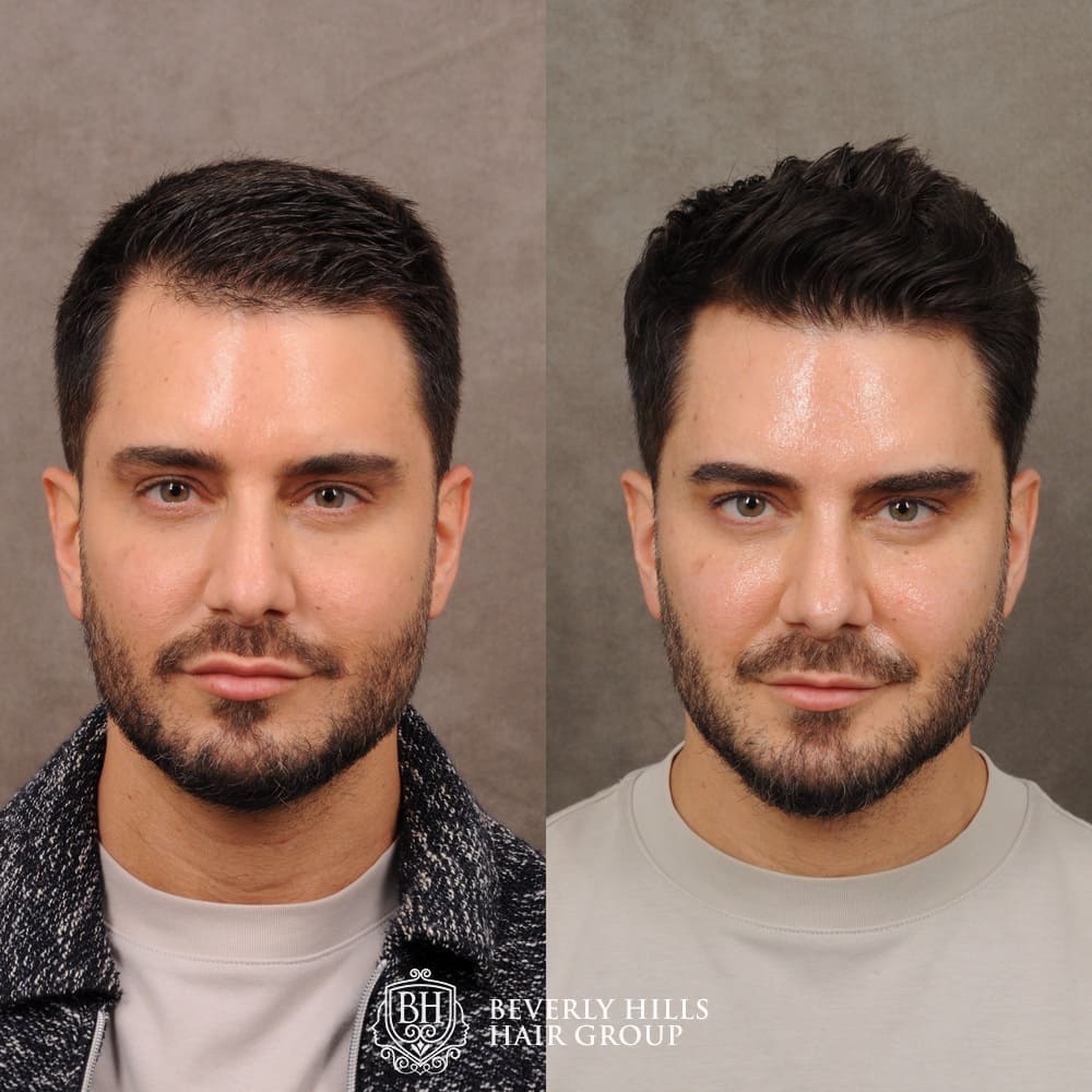 Hair Transplant Without Shaving: Risks and Benefits | DR. Cinik