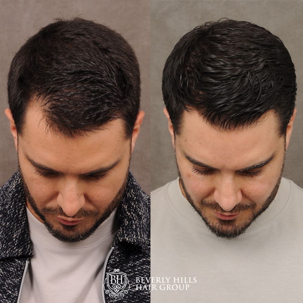Dallas Asian Hair Transplant Before and After Photos - Plano Plastic  Surgery Photo Gallery - Dr. Samuel LamAsian Hair Transplant Archives | Lam,  Sam (hairtx.com)