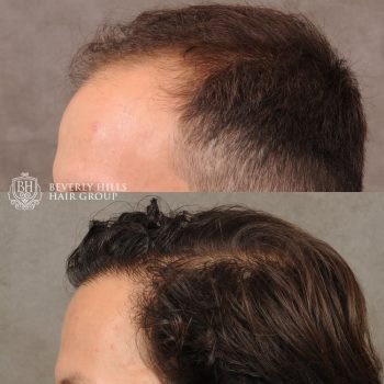 FUE Hair Transplant with 2,500 grafts and a treatment of PRP therapy
