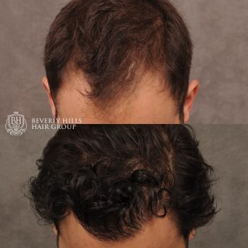FUE Hair Transplant with 2,500 grafts and a treatment of PRP therapy