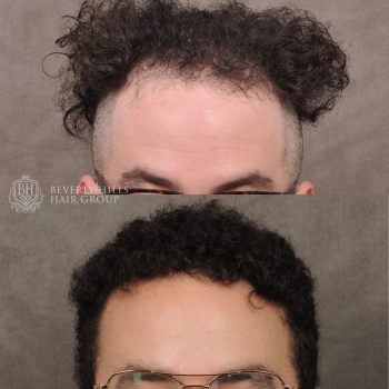 FUE hair transplant with 2,000 grafts and a treatment of PRP therapy