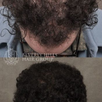 FUE hair transplant with 2,000 grafts and a treatment of PRP therapy