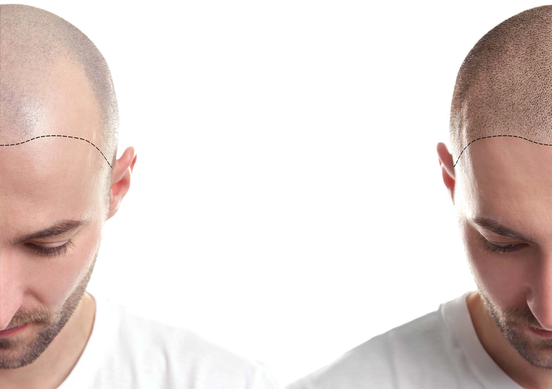 Before and after hair transplantation.