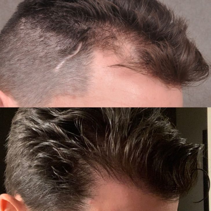 Before and after images of a man's hair restoration on his temple, showing improved hair density and coverage.
