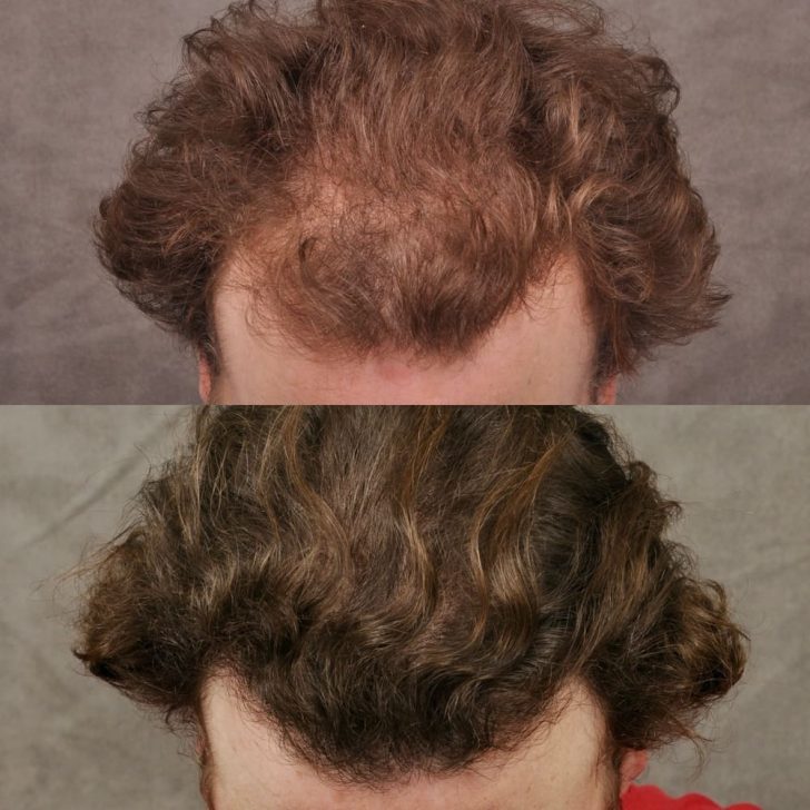 Two side-by-side images showing a person's hair before and after treatment. The top image shows thinning hair, while the bottom shows fuller, thicker hair.