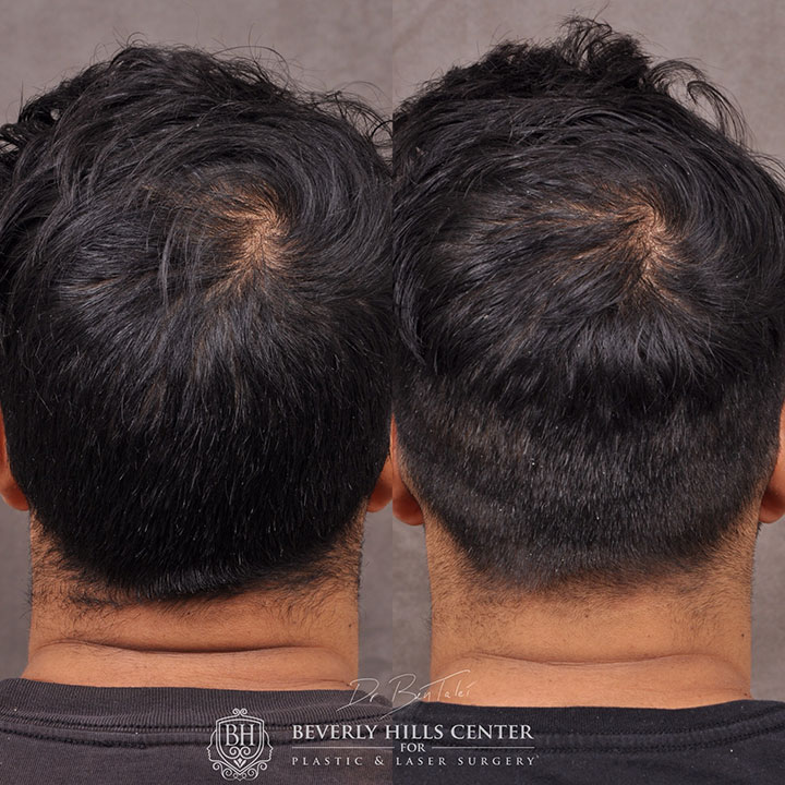 Before and after comparison of a man's hair restoration procedure, showing increased hair density on top of the head.