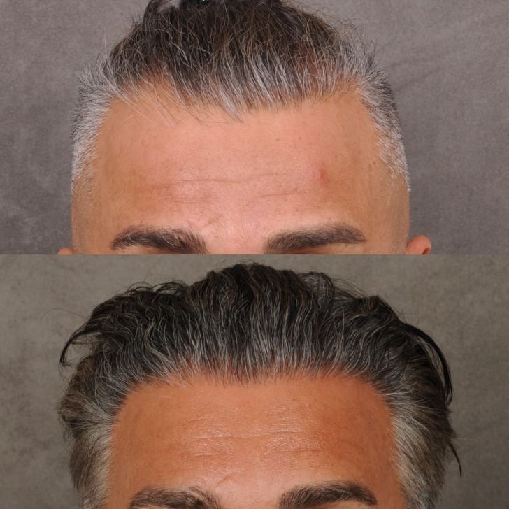 Close-up comparison of a man's head with thinning gray hair in the top image and thicker styled hair in the bottom image.