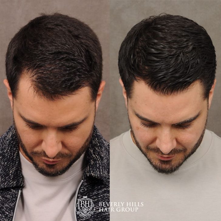 Side-by-side images of a man's head, before and after hair restoration treatment, showing fuller hair in the after image.
