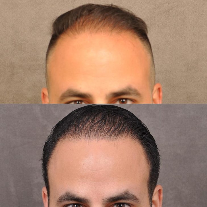 Before and after images of a man's head showing hair restoration. The top image depicts thinning hair, while the bottom image shows fuller hair coverage.
