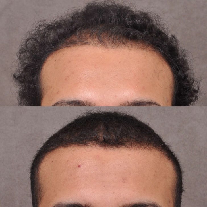 Two images showing the top of a person's head before and after a hair restoration procedure. The top image shows thinning hair, while the bottom image shows fuller hair.