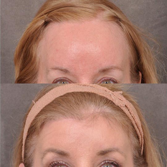 Top and bottom images compare a person's forehead and eyes, highlighting skin and hair changes.