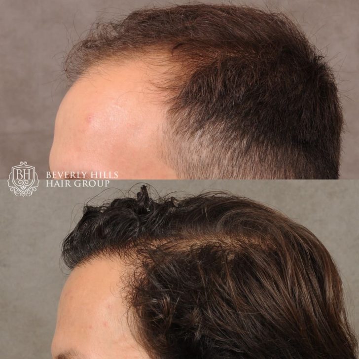 Two side-by-side images showing a close-up of a person's scalp. The first image shows thinning hair, and the second image shows fuller hair after treatment.
