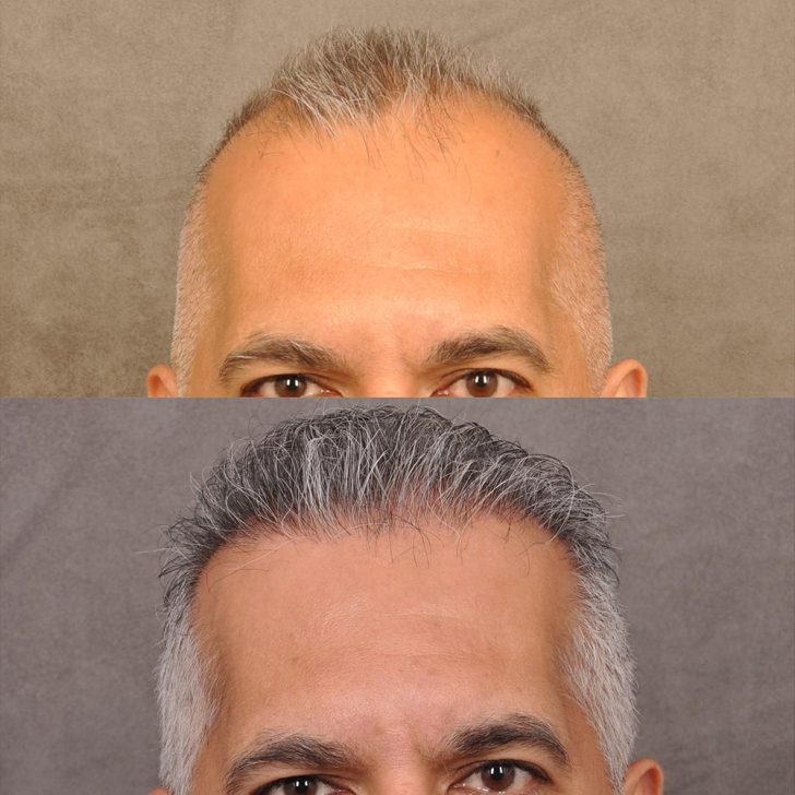 Before and after images of a man's hair restoration, showing increased hair density and coverage on the top of his head.