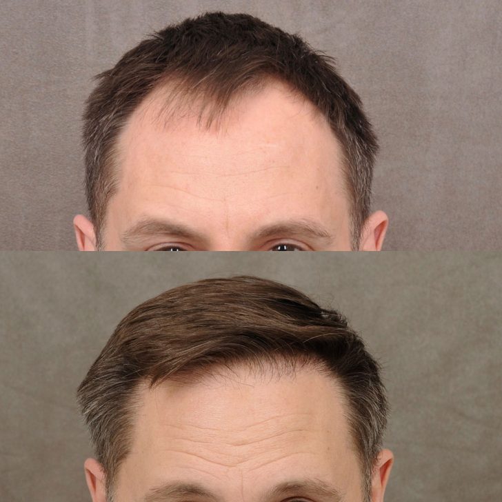 Before and after images of a man's hair restoration. Top shows thinner hair, bottom shows fuller hair and improved hairline.
