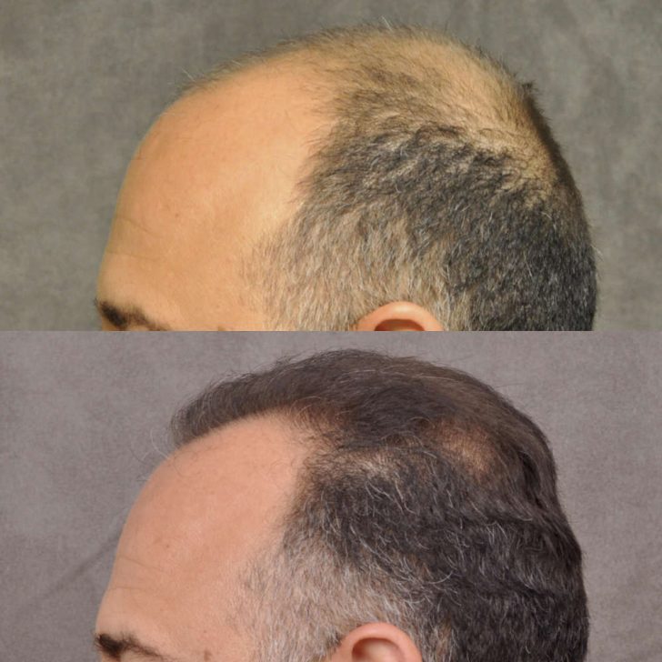 Comparison of the side view of a man's head before and after hair restoration, showing increased hair density and coverage in the after image.