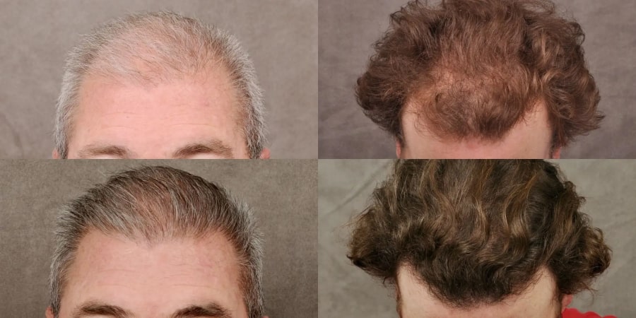 Before and after images showing hair restoration for two individuals; the top row shows thinning hair, and the bottom row shows fuller hair.