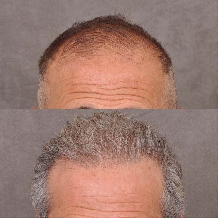 Before and after comparison of a man with thinning hair on top and fuller, thicker hair below on a grey background.