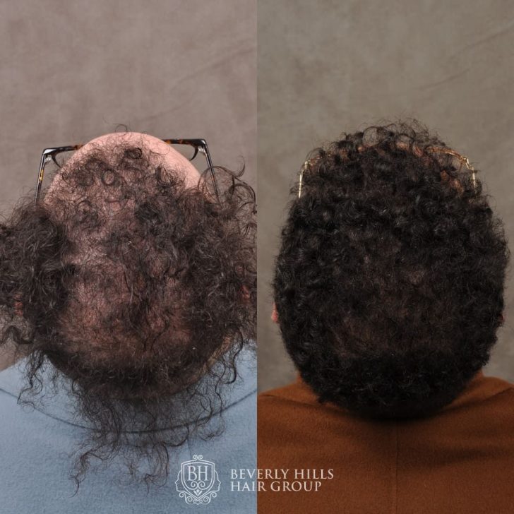Before and after images of a person's head from above, showing hair transformation with fuller curls on the right.