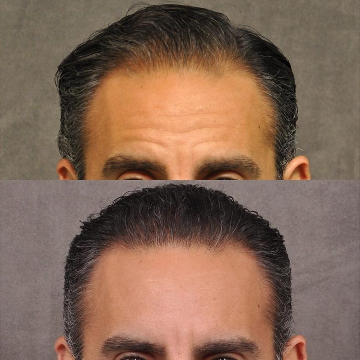 Before and after hair transplant comparison showing the top section of a man's head with visible hair restoration in the after image.