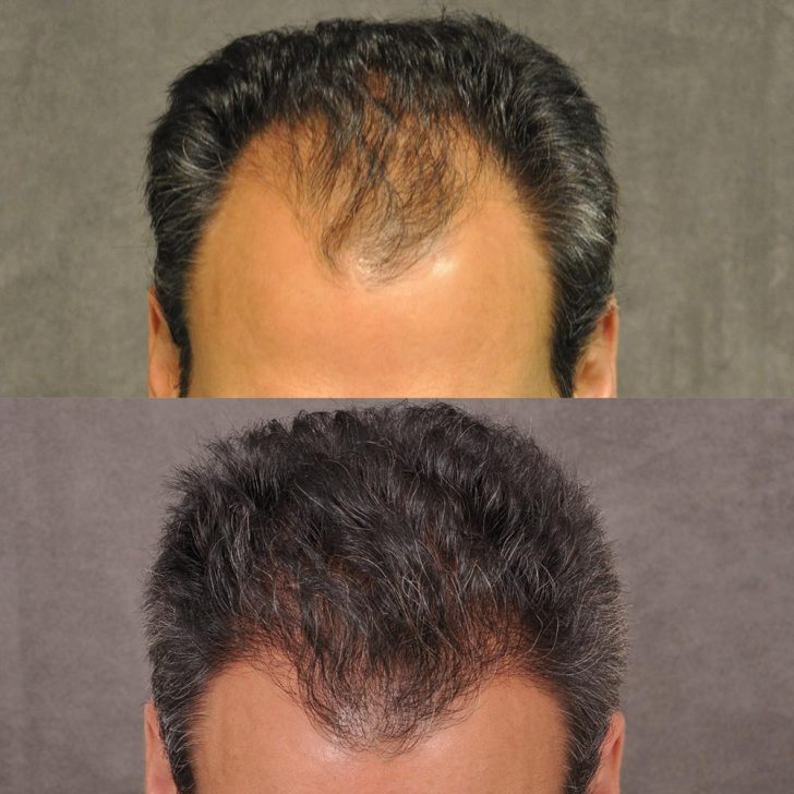 Before and after images of a man's hair restoration, showing fuller hair and improved hairline in the after photo.