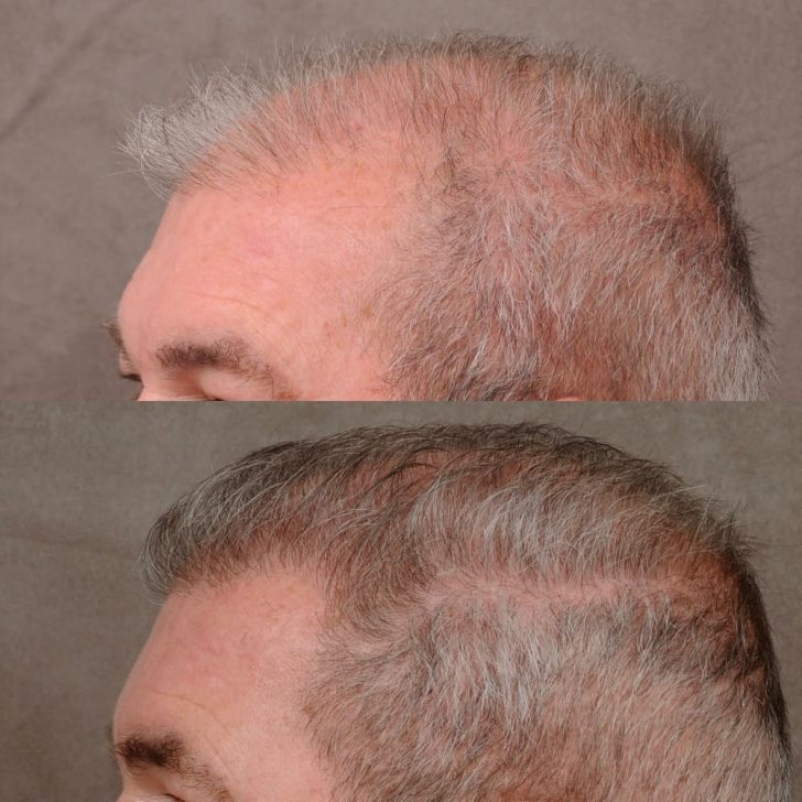Two side-by-side images show a man's head before and after hair restoration, highlighting increased hair density in the after image.
