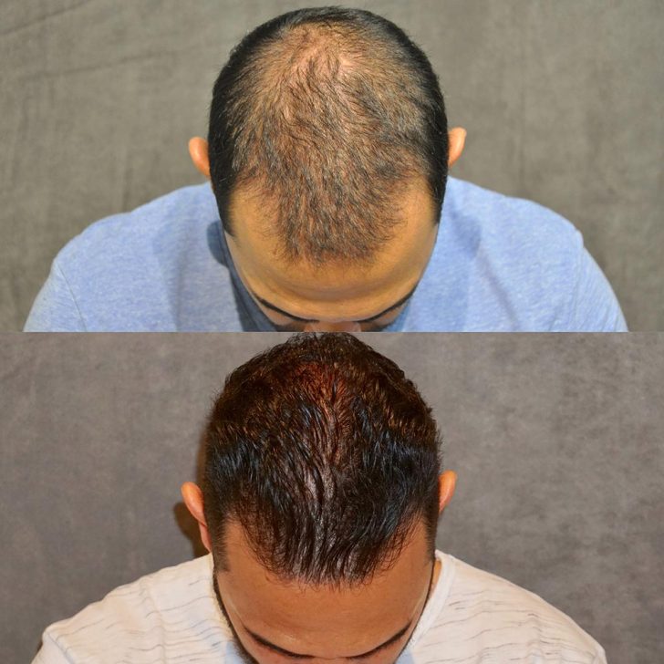 Before and after image showing the top of a man's head. The first shows hair thinning, and the second shows fuller hair.