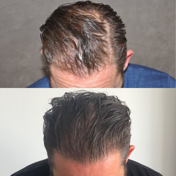 Two images of a man's head showing hair before and after a thinning or balding treatment. The top image shows thinning hair, while the bottom image shows fuller hair.