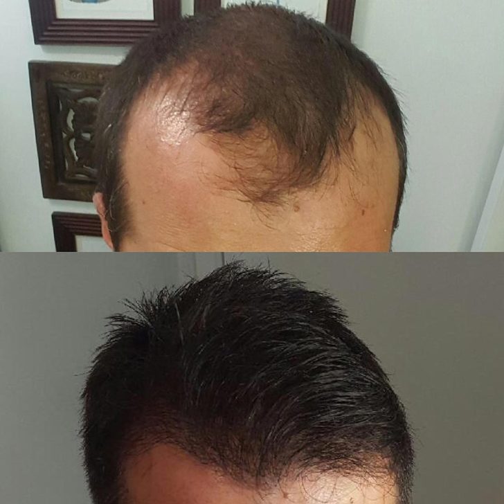 Before and after images of a person's head show hair loss in the first image and full, dark hair in the second.