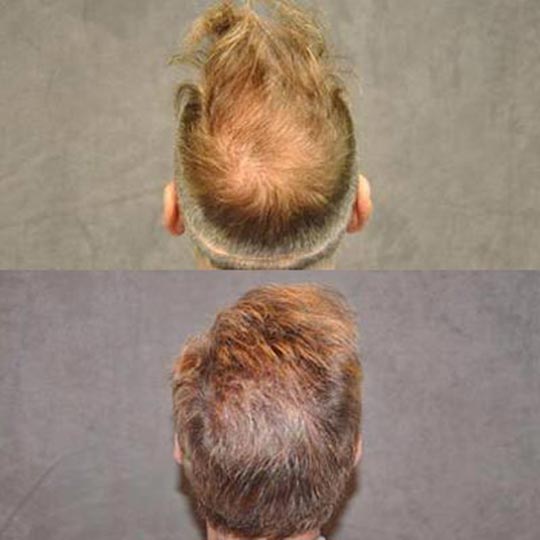 A before-and-after comparison of the back of a person's head showing hair restoration results.
