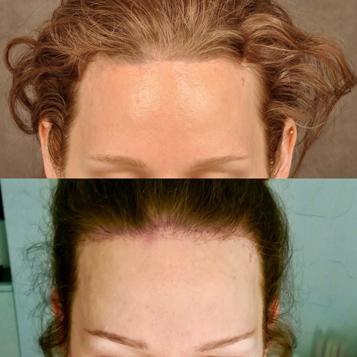 Top image shows a forehead with curly brown hair. Bottom image shows a forehead with hairline redness, likely after a treatment or procedure.