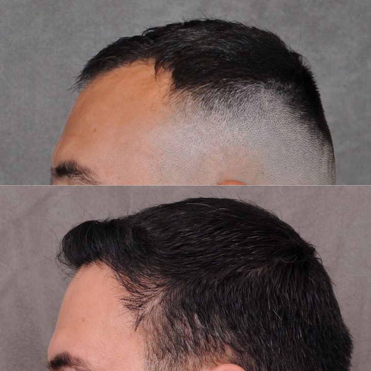 Side-by-side comparison of a man's head before and after a hair transplant. The top image shows thinning hair, while the bottom image displays a fuller head of hair.