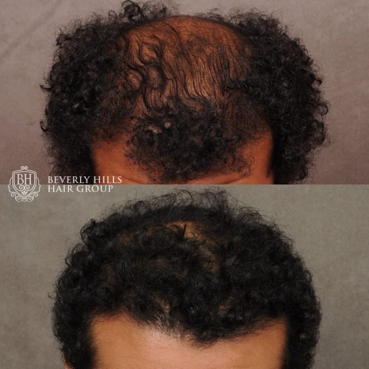 Top image: Person with thinning curly hair on the top of the head. Bottom image: Same person with fuller curly hair coverage.
