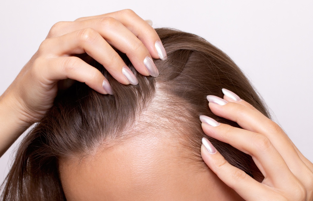 Young woman showing bald spots on forehead and temples with fingers. Baldness. Close-up. Hair care concept and treatment. Hair loss, hair transplant, alopecia